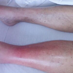 HT10. Attention: Recognizing Early Signs of Dangerous Infections